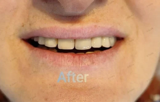 Dental case image: Dental Micro Prosthetics for a Semi-Rigid Restoration