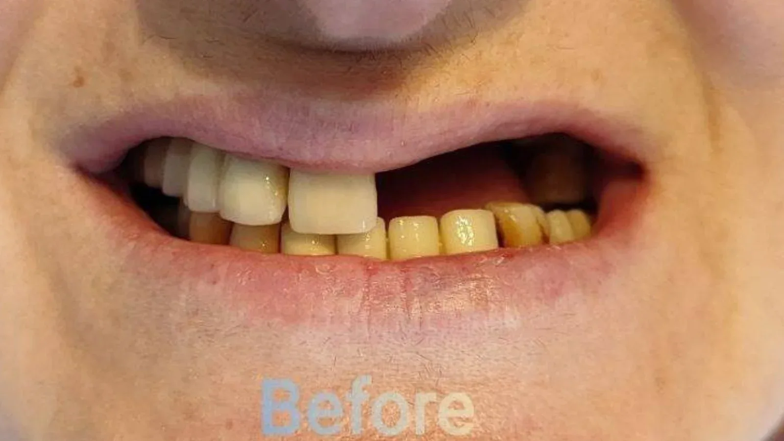 Dental Micro Prosthetics for a Semi-Rigid Restoration
