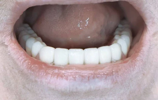 Dental case image: Lower Semi-Flexible Denture for a Comfortable Smile…