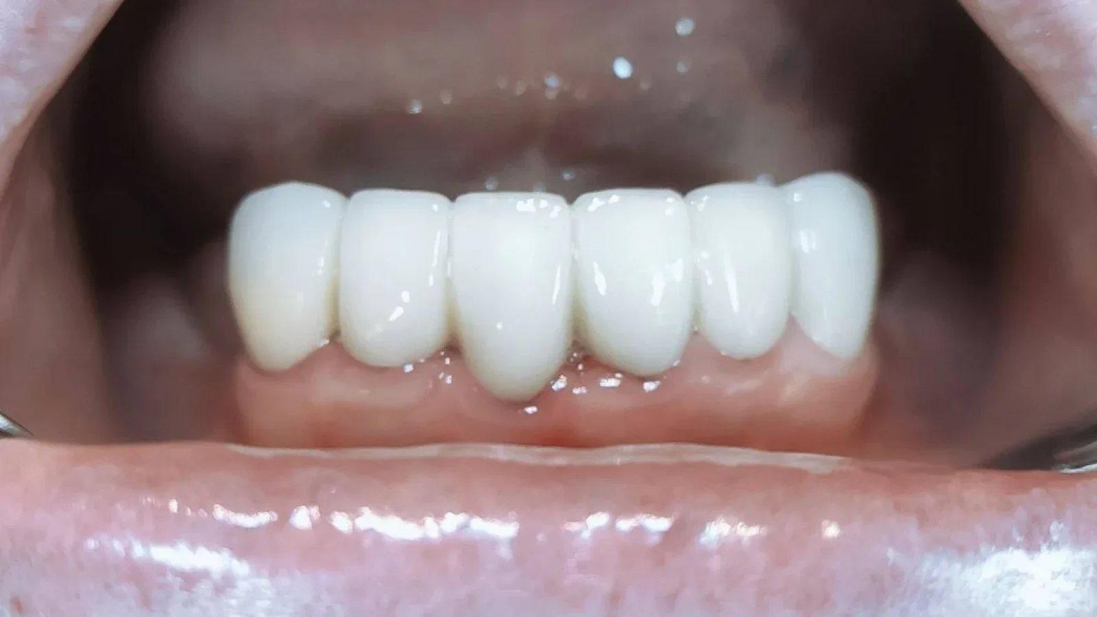 Lower Semi-Flexible Denture for a Comfortable Smile Restoration