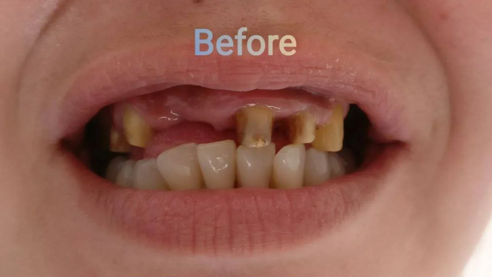 Metal-Ceramic Crowns and Bridges Restoration