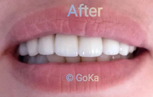 Dental case image: Metal-Ceramic Crowns and Bridges Restoration