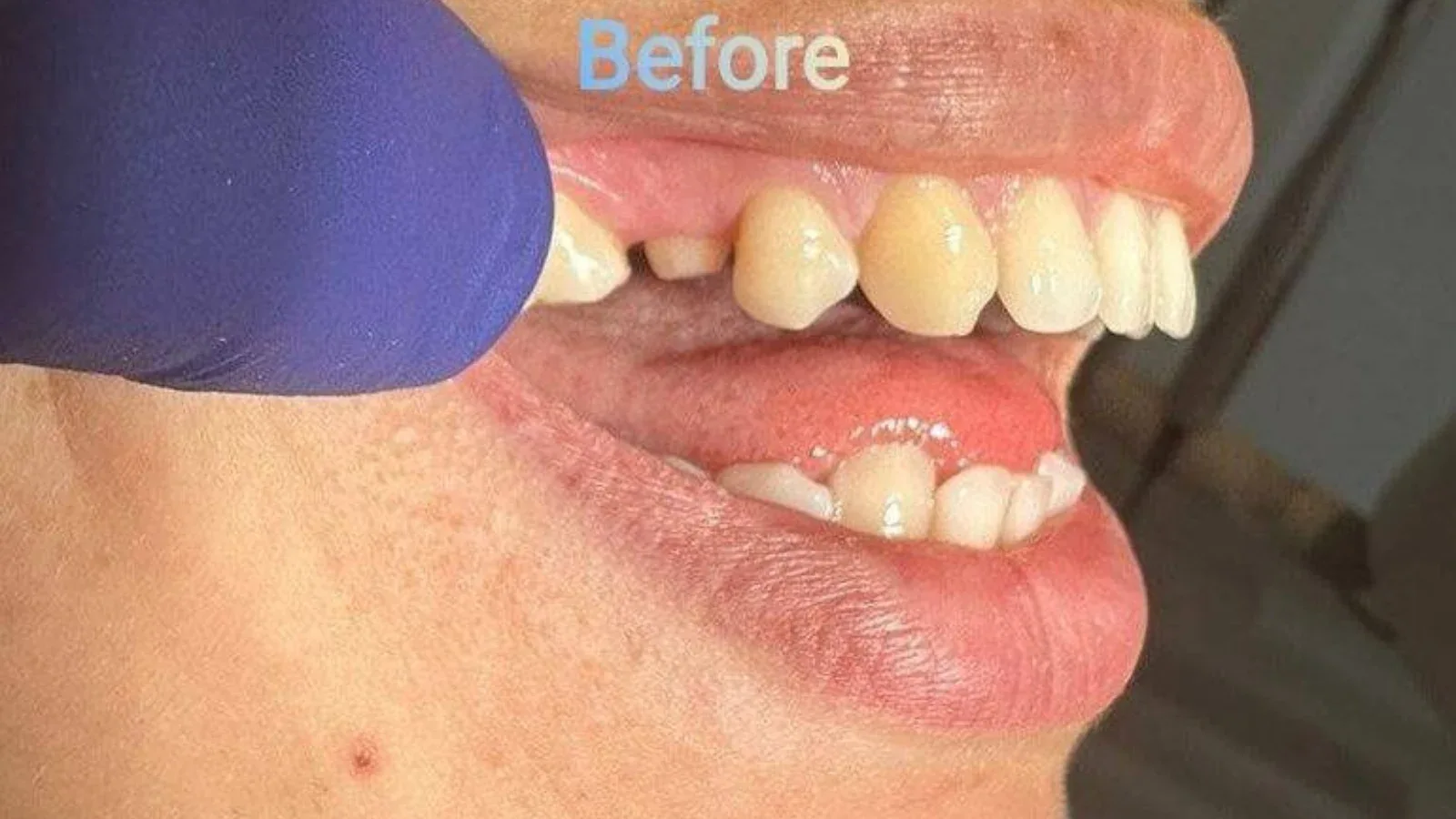 Zirconia Tooth Restoration for a Palatally Positioned Tooth