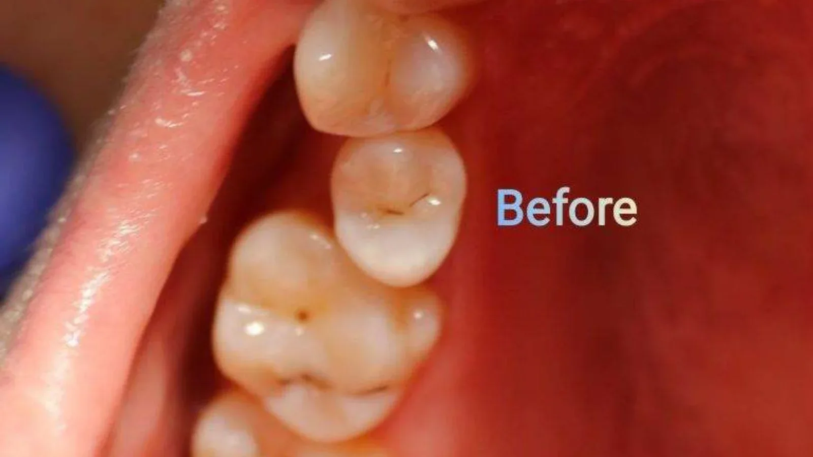 Zirconia Tooth Restoration for a Palatally Positioned Tooth