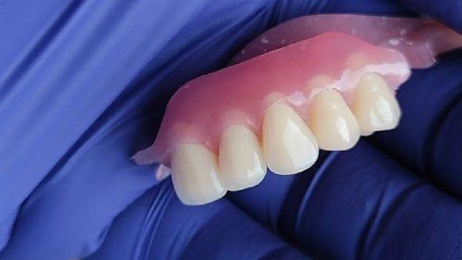 Dental Micro Prosthetics for a Semi-Rigid Restoration