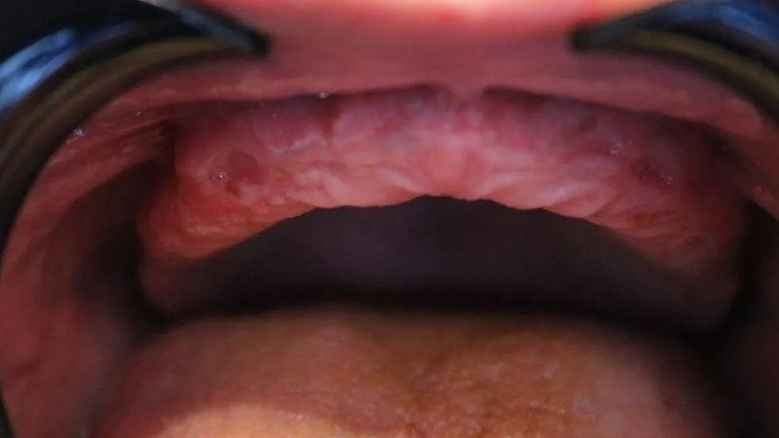 Upper Acrylic Denture for a Clean Smile Restoration