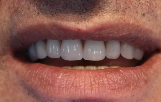 Dental case image: Upper Acrylic Denture for a Clean Smile Restoration