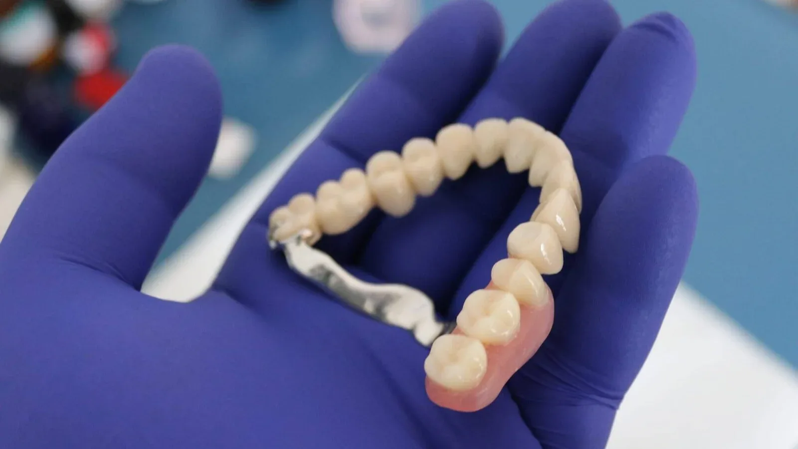 Dentures on Attachments for Upper Jaw Restoration