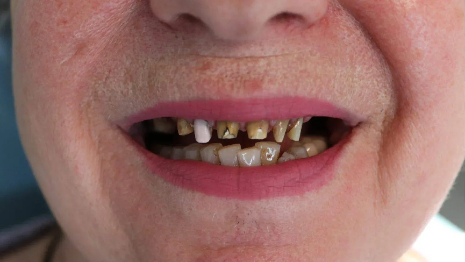 Dentures on Attachments for Upper Jaw Restoration