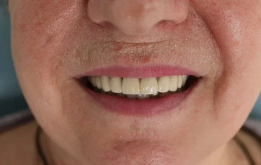 Dental case image: Dentures on Attachments for Upper Jaw Restoration