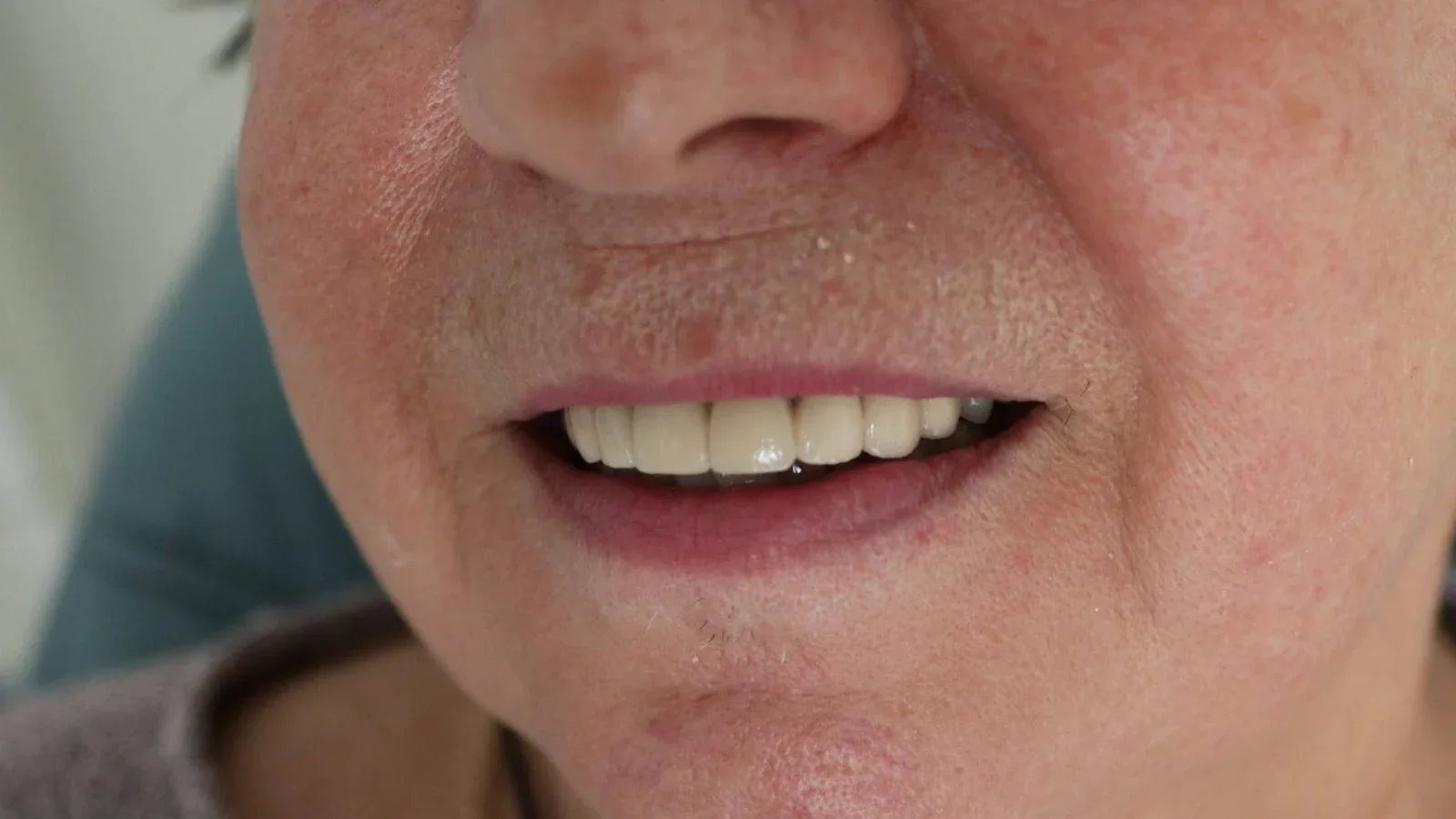Dentures on Attachments for Upper Jaw Restoration