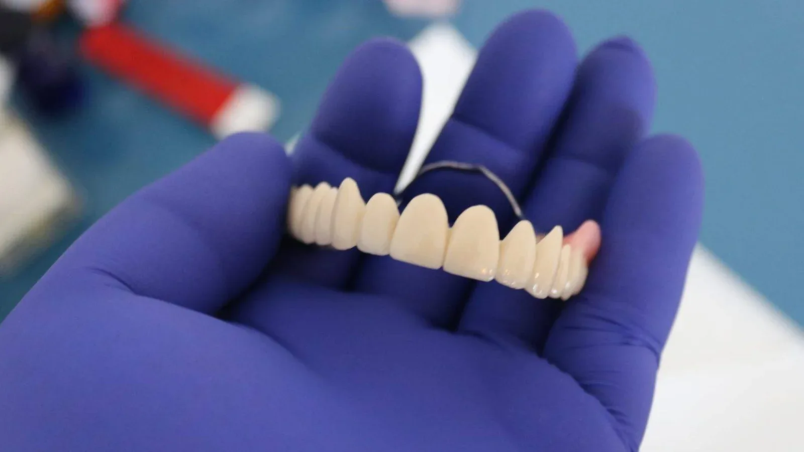 Dentures on Attachments for Upper Jaw Restoration