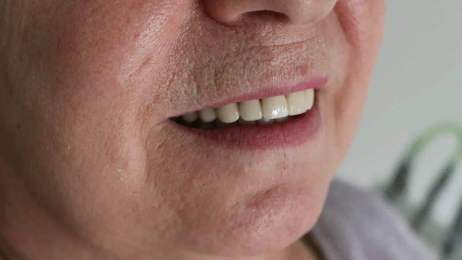 Dentures on Attachments for Upper Jaw Restoration