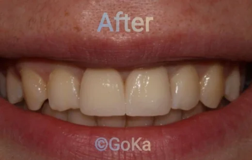 Dental case image: Dental Crown Restoration for Fractured Front Teeth