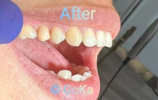 Dental case image: Zirconia Tooth Restoration for a Palatally Positioned Tooth