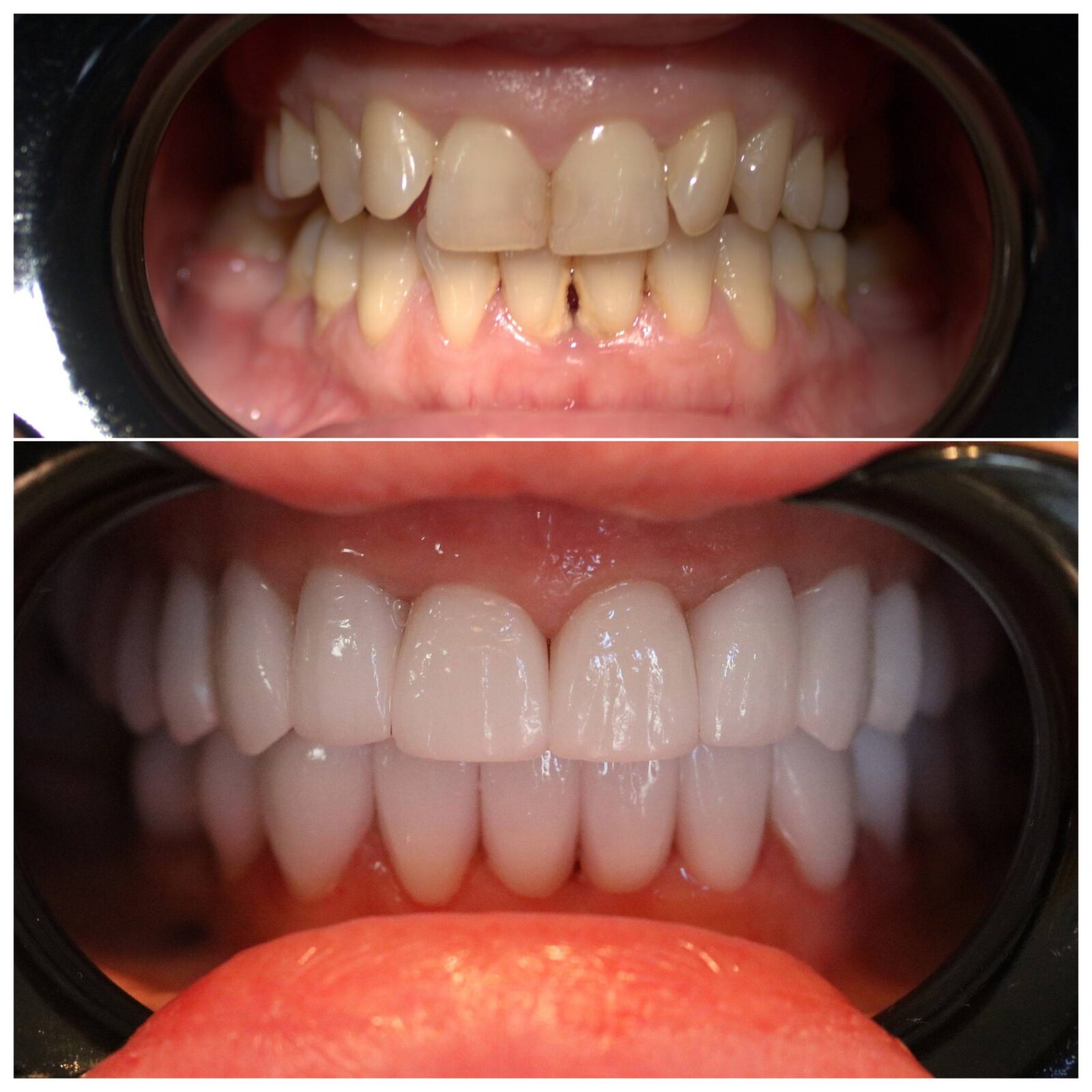 Zirconia restoration for a young female patient