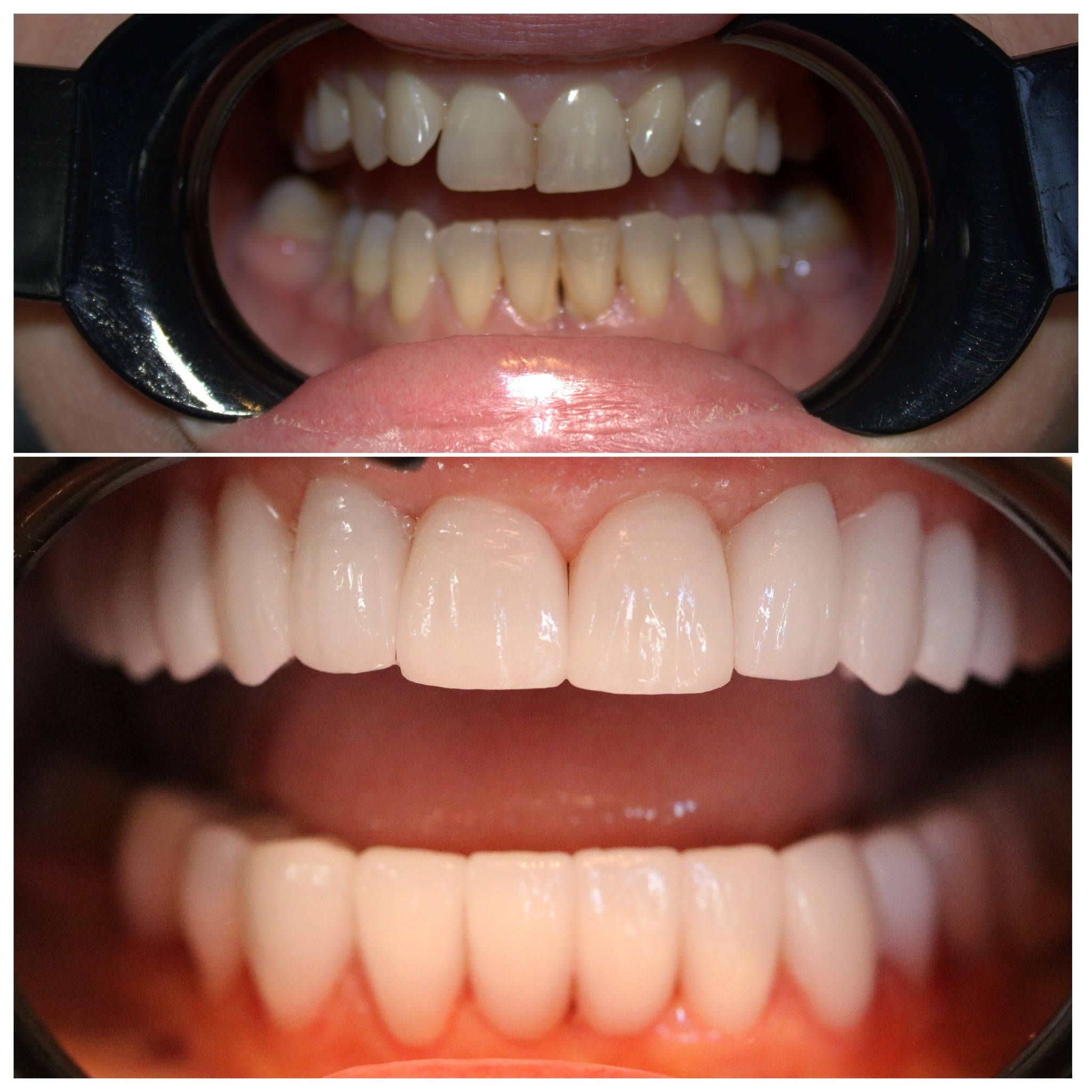 Οδοντική Στεφάνη Ζιρκον