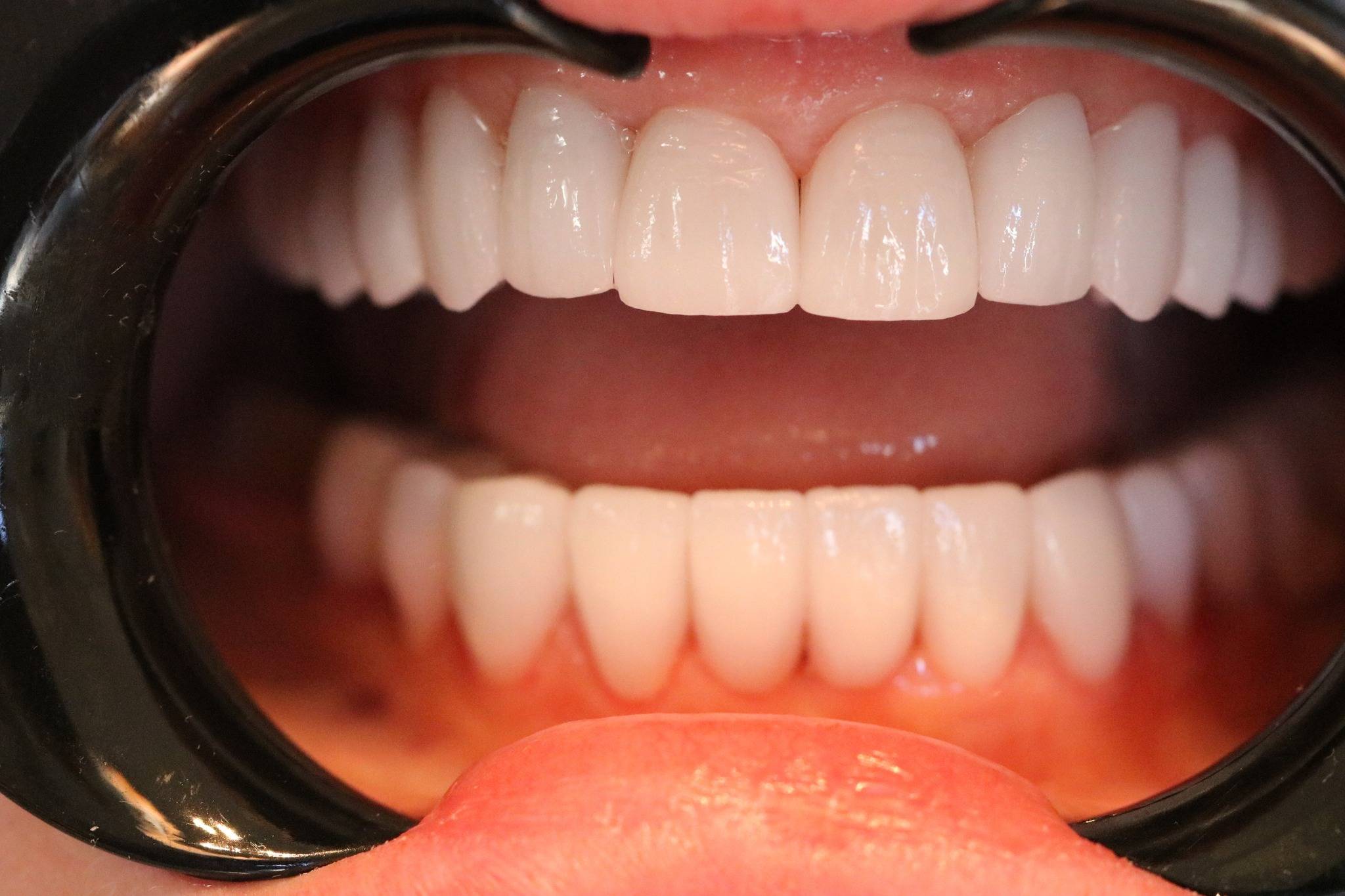 Οδοντική Στεφάνη Ζιρκονίου