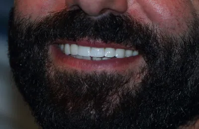 Aesthetic zirconia teeth restoration for a perfect smile