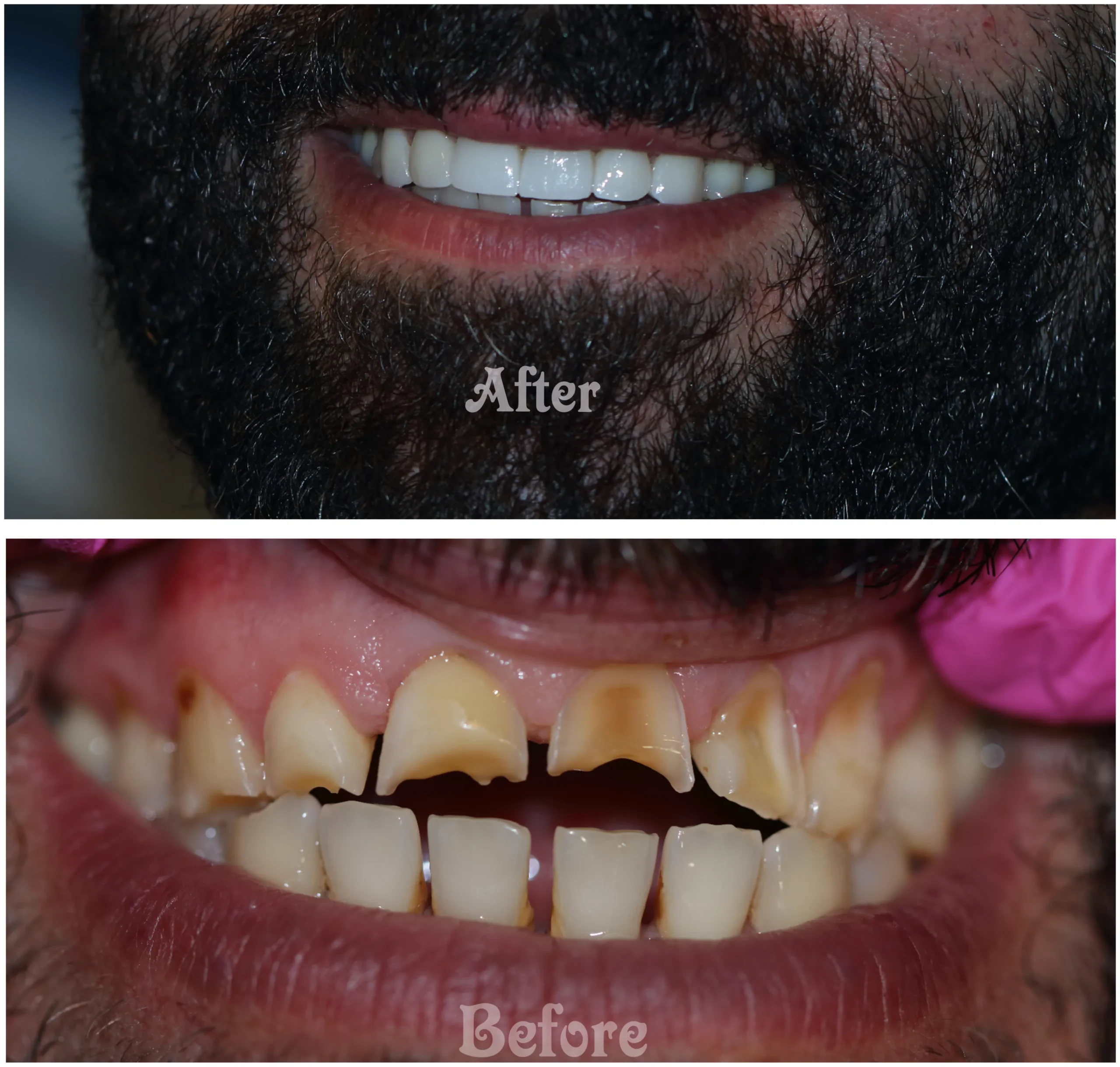 Aesthetic zirconia teeth restoration for a perfect smile