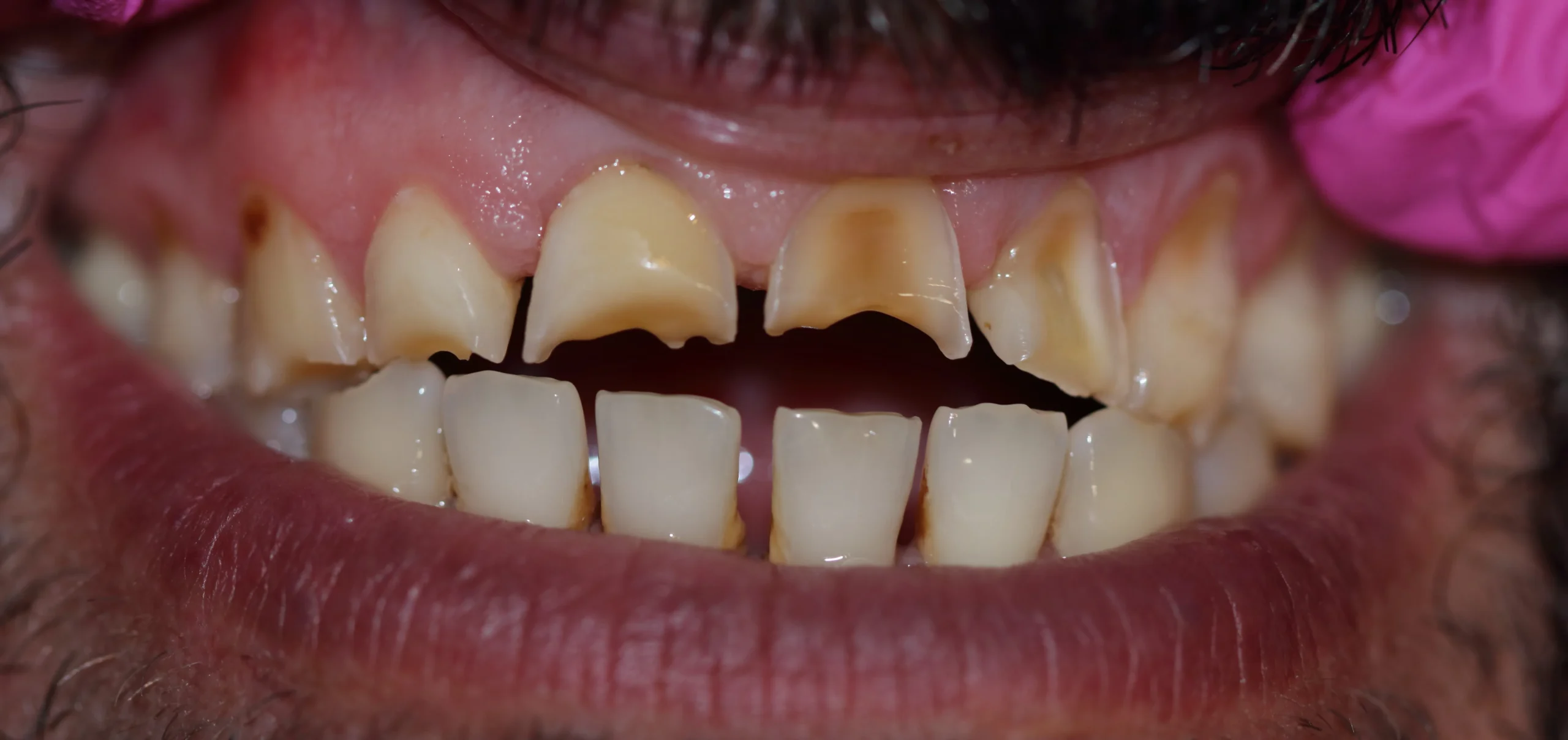 Aesthetic zirconia teeth restoration for a perfect smile
