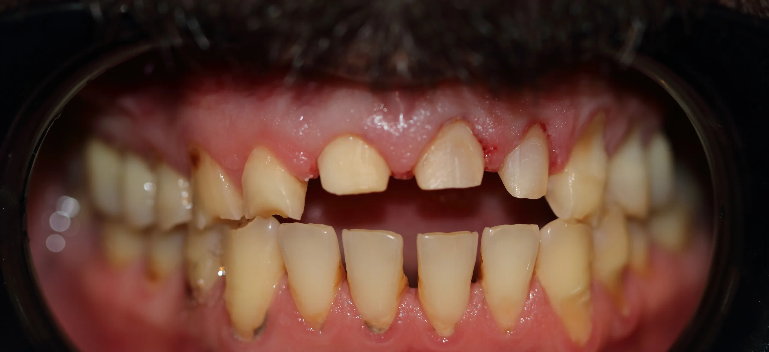 Aesthetic zirconia teeth restoration for a perfect smile