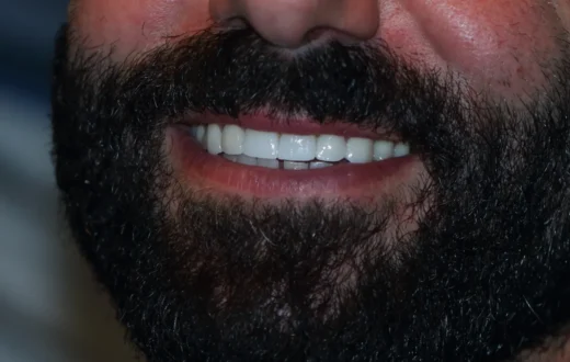 Dental case image: Aesthetic Zirconia Restoration for a Male Patient