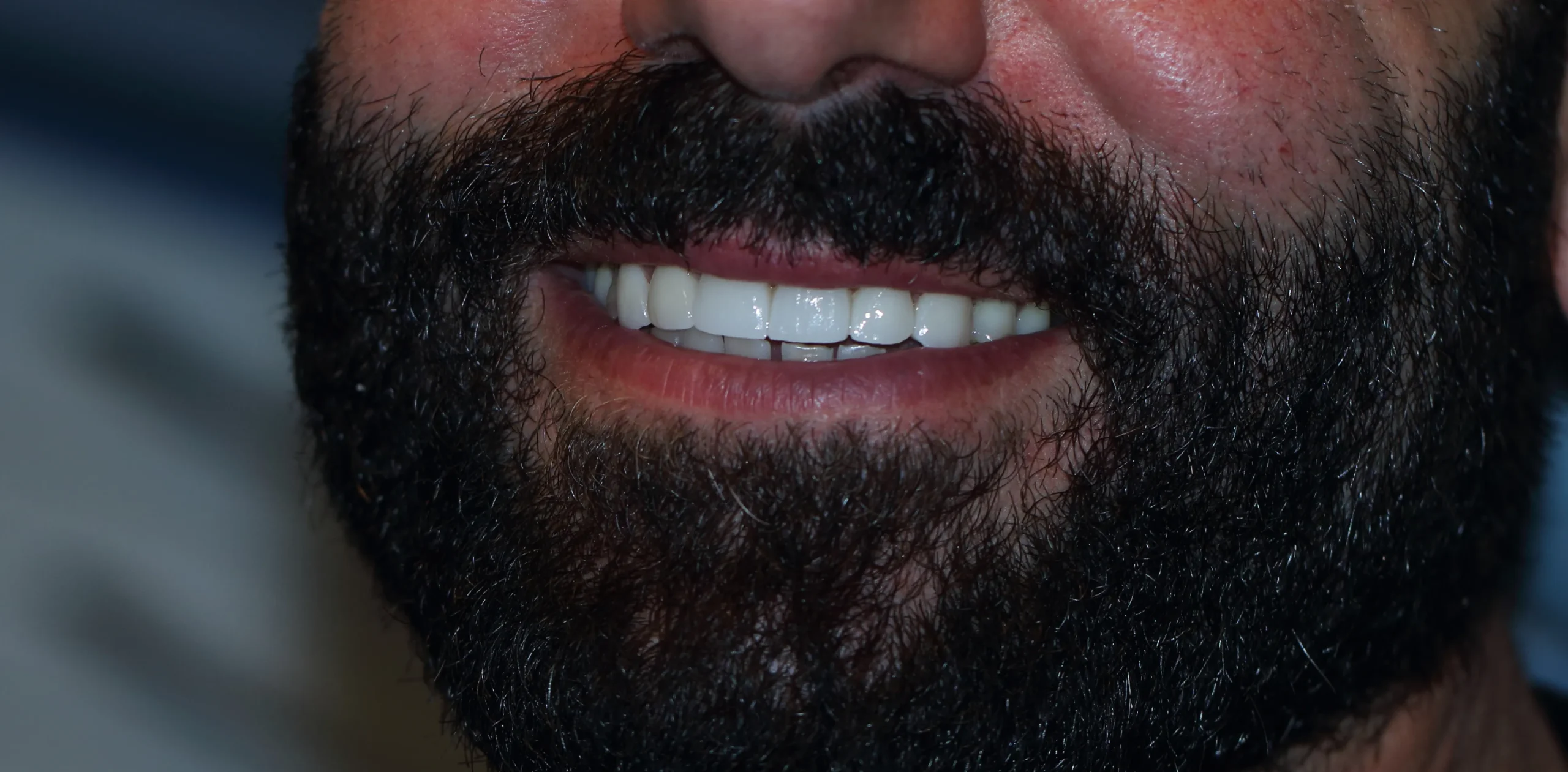 Aesthetic zirconia teeth restoration for a perfect smile