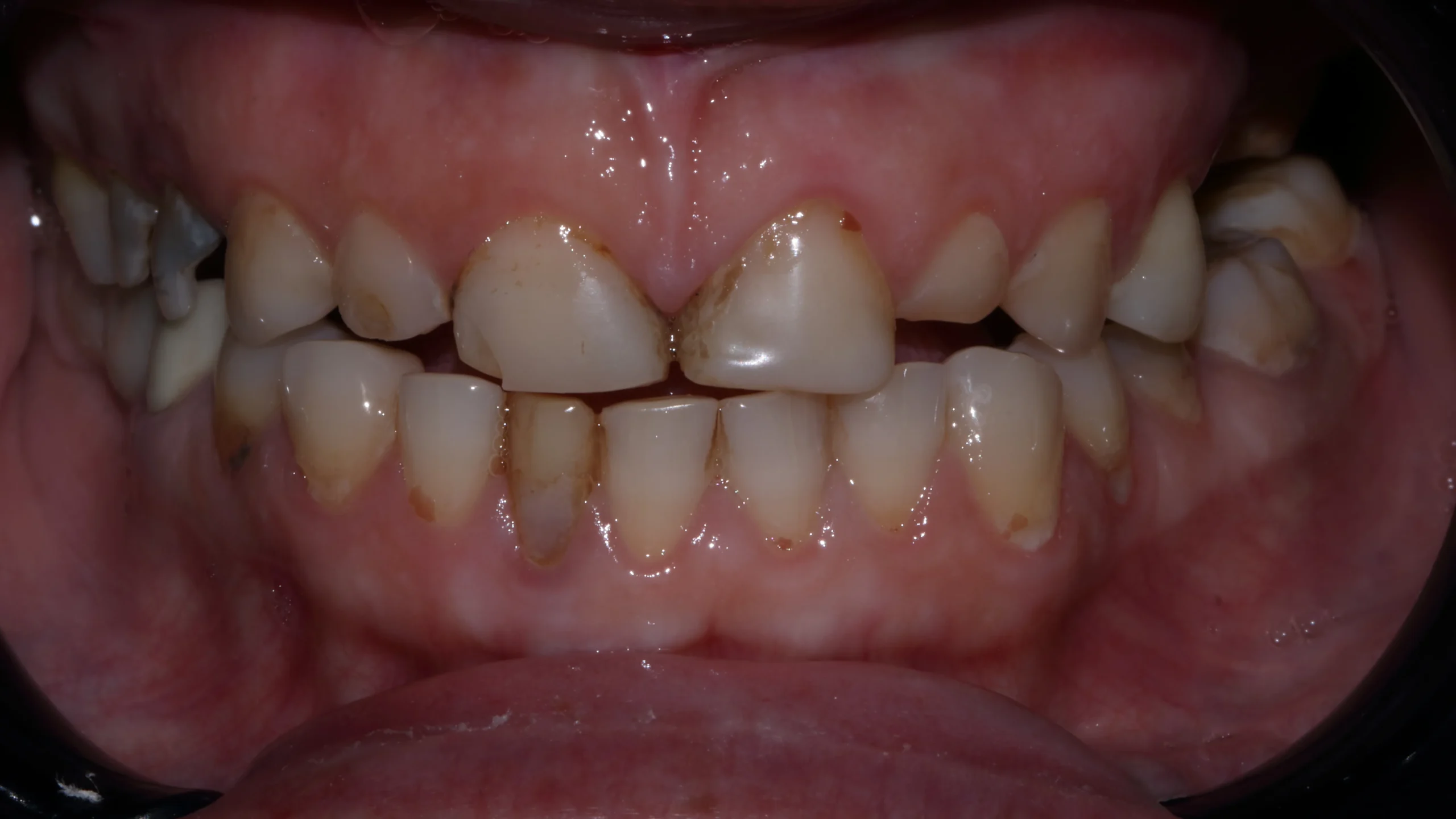Full Zirconia Dental Restoration