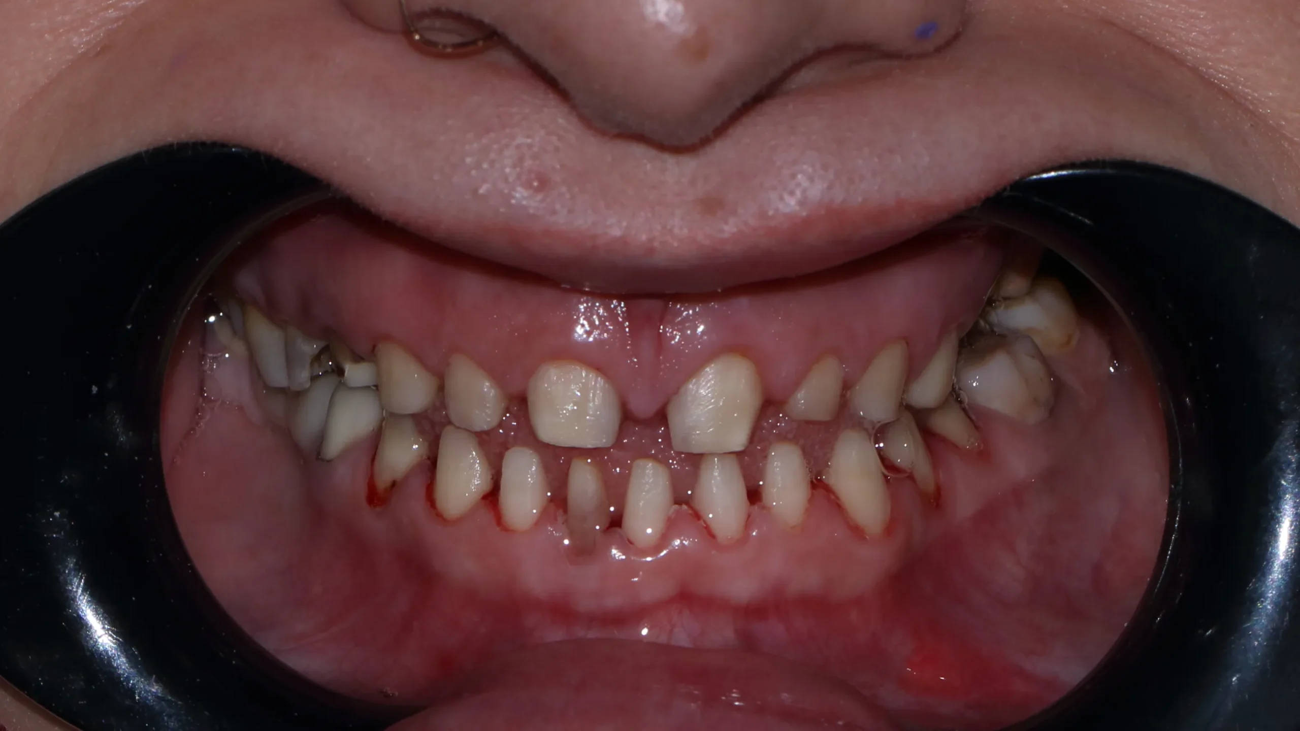 Full Zirconia Dental Restoration