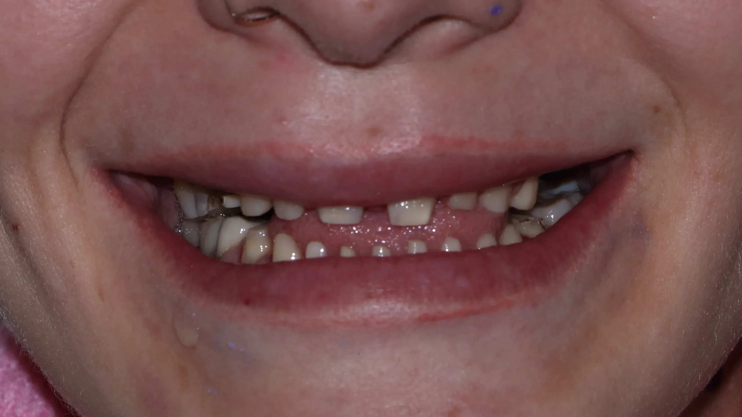 Full Zirconia Dental Restoration