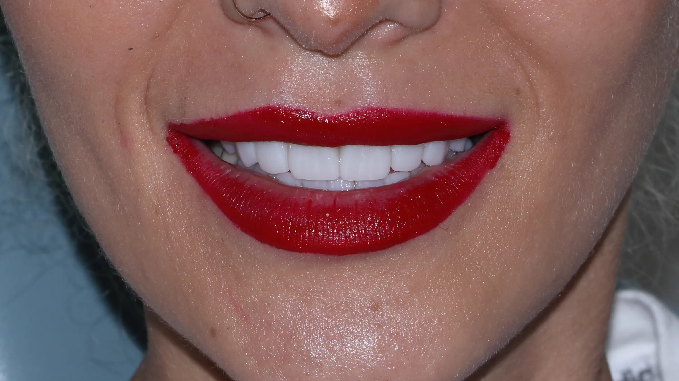 Full Zirconia Dental Restoration
