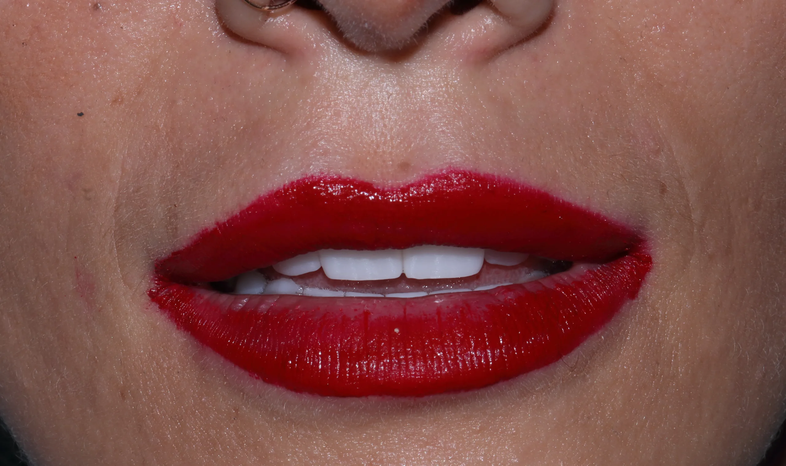 Full Zirconia Dental Restoration