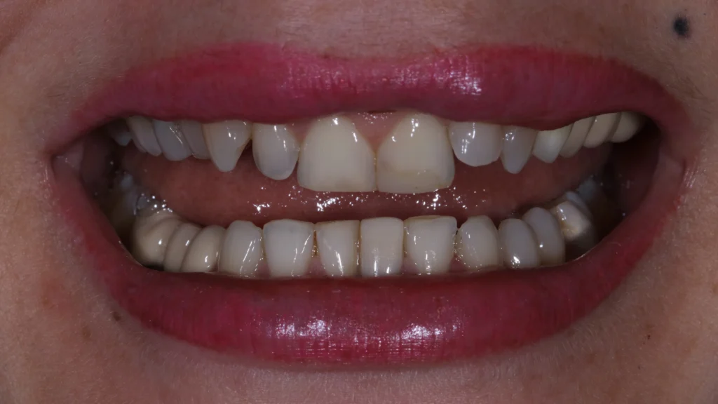 Full zirconia teeth restoration for the upper and lower jaw