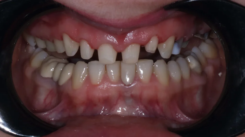 Full zirconia teeth restoration for the upper and lower jaw