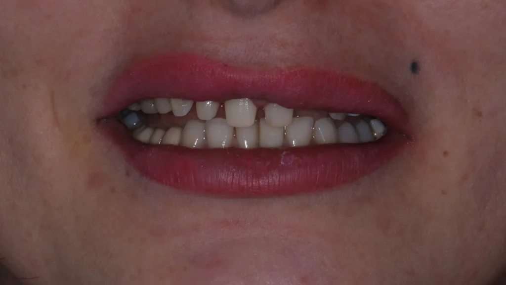 Full zirconia teeth restoration for the upper and lower jaw