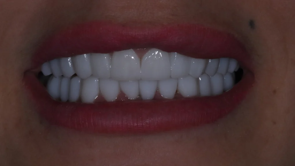 Full zirconia teeth restoration for the upper and lower jaw