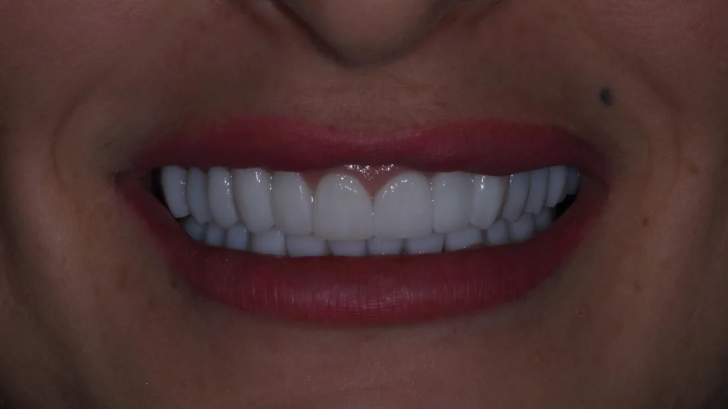 Full zirconia teeth restoration for the upper and lower jaw