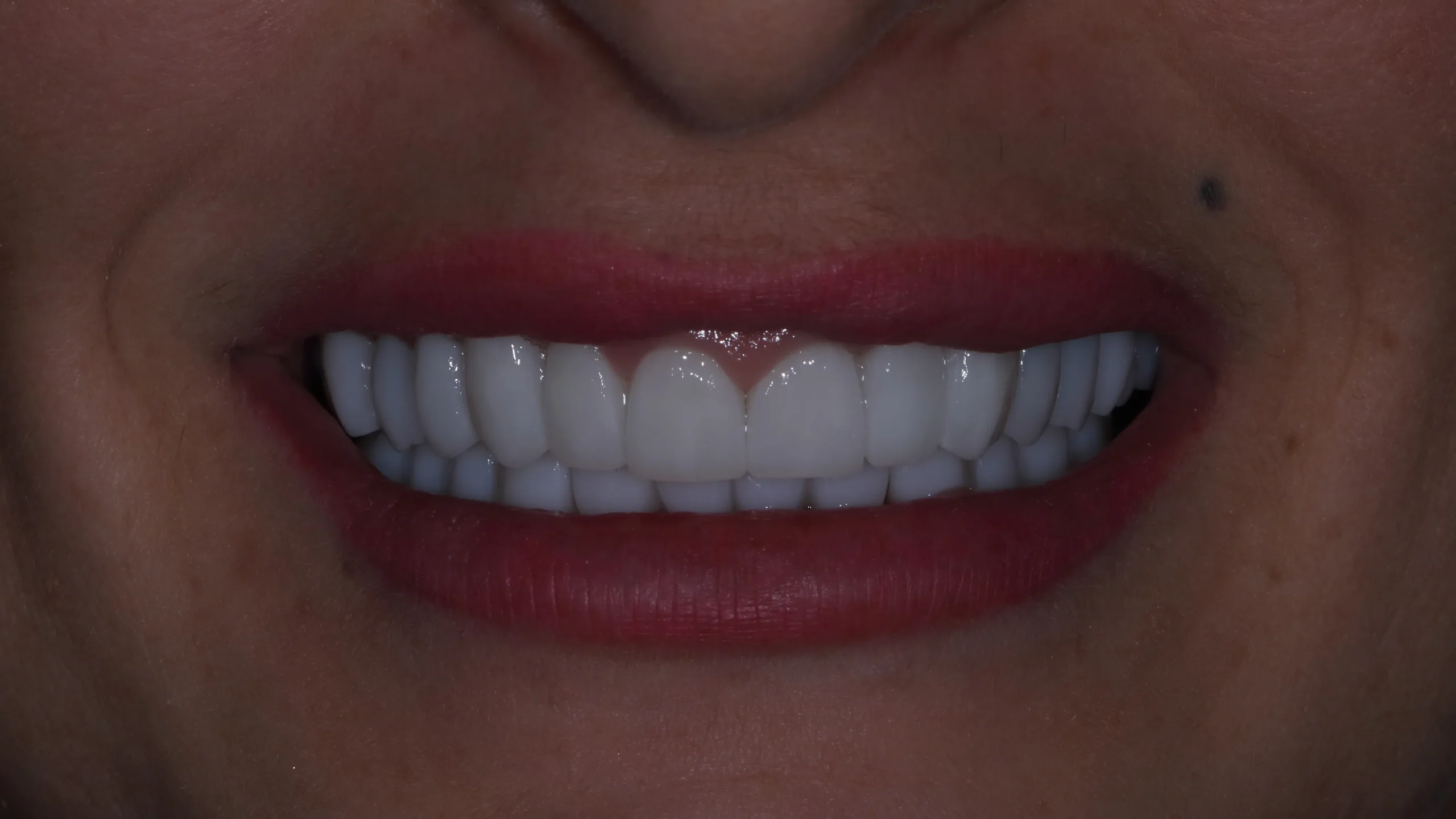 Full zirconia teeth restoration for the upper and lower jaw