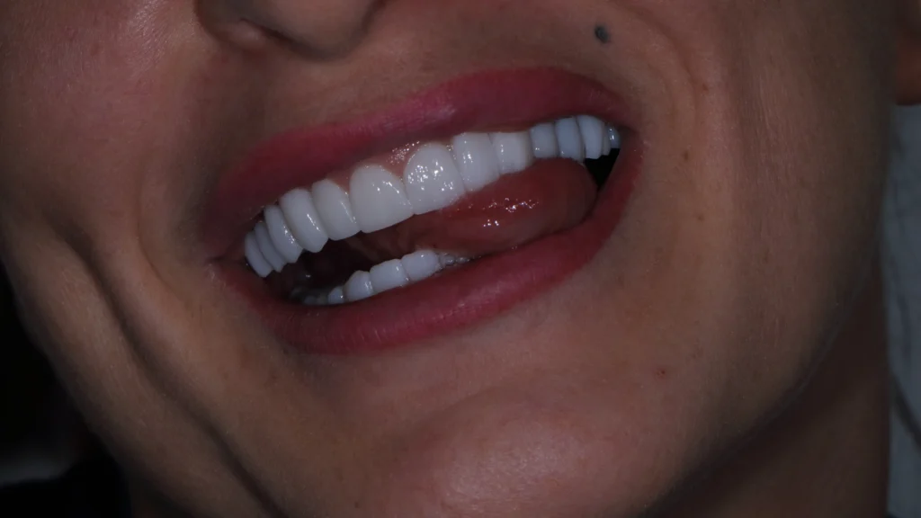 Full zirconia teeth restoration for the upper and lower jaw