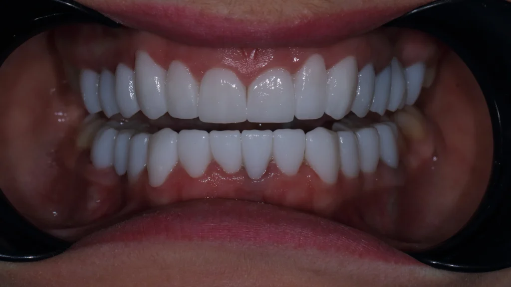 Full zirconia teeth restoration for the upper and lower jaw