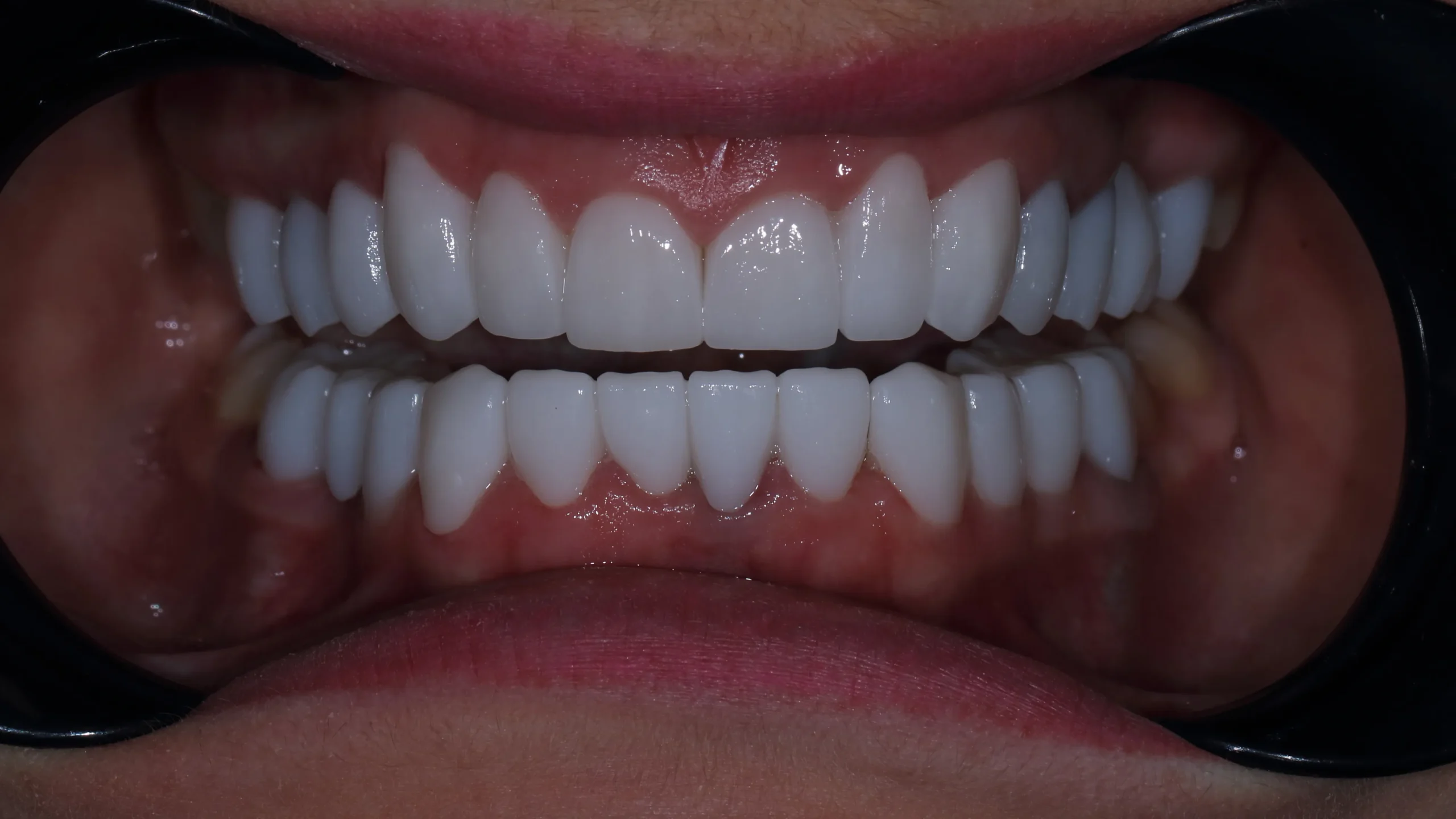Full zirconia teeth restoration for the upper and lower jaw