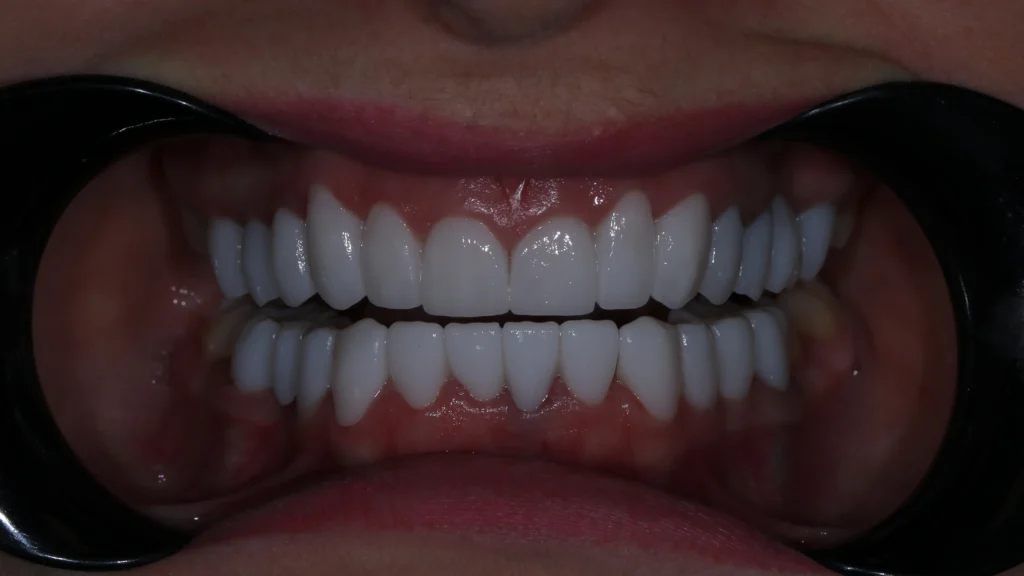 Full zirconia teeth restoration for the upper and lower jaw