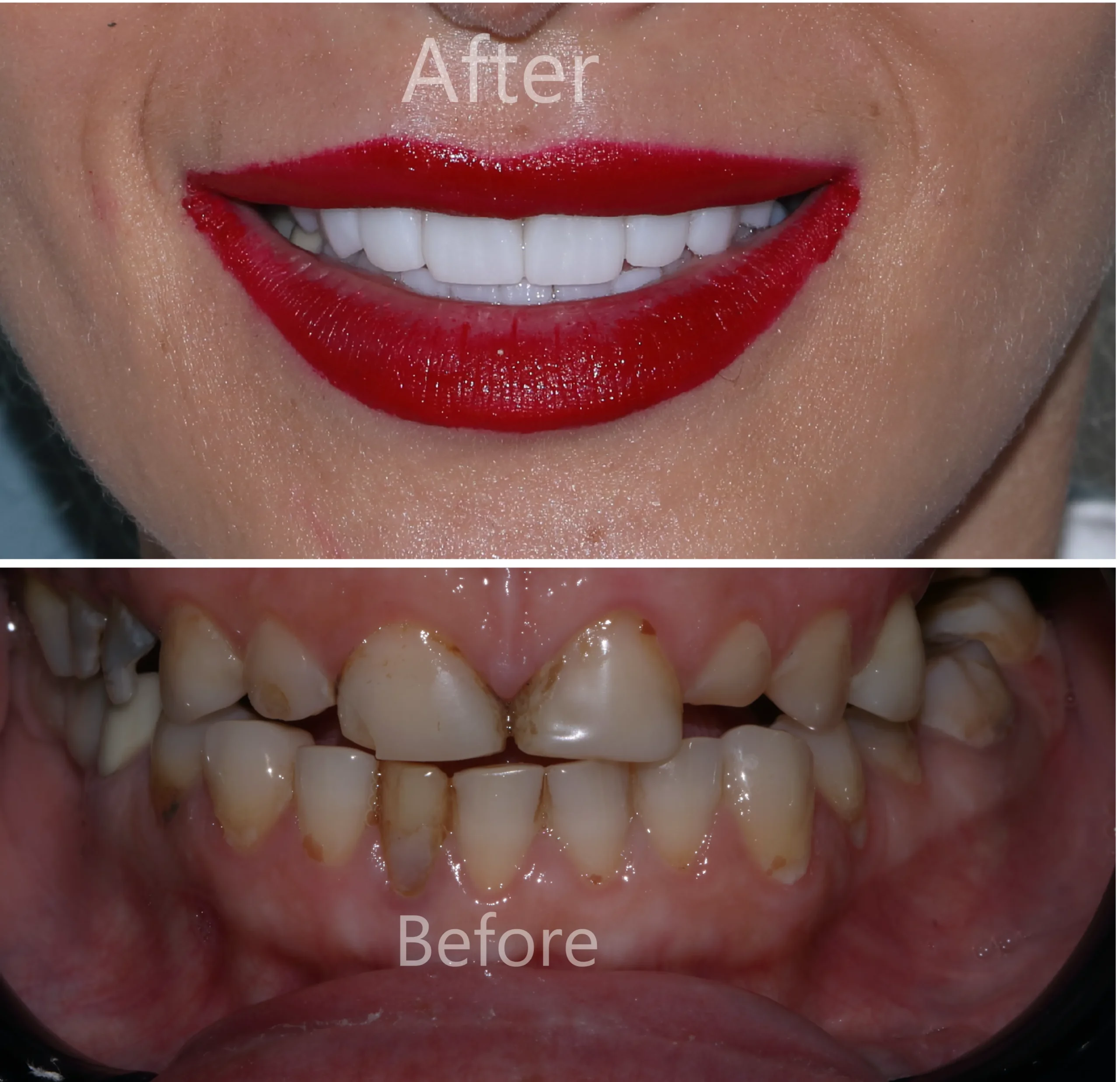 Full Zirconia Dental Restoration