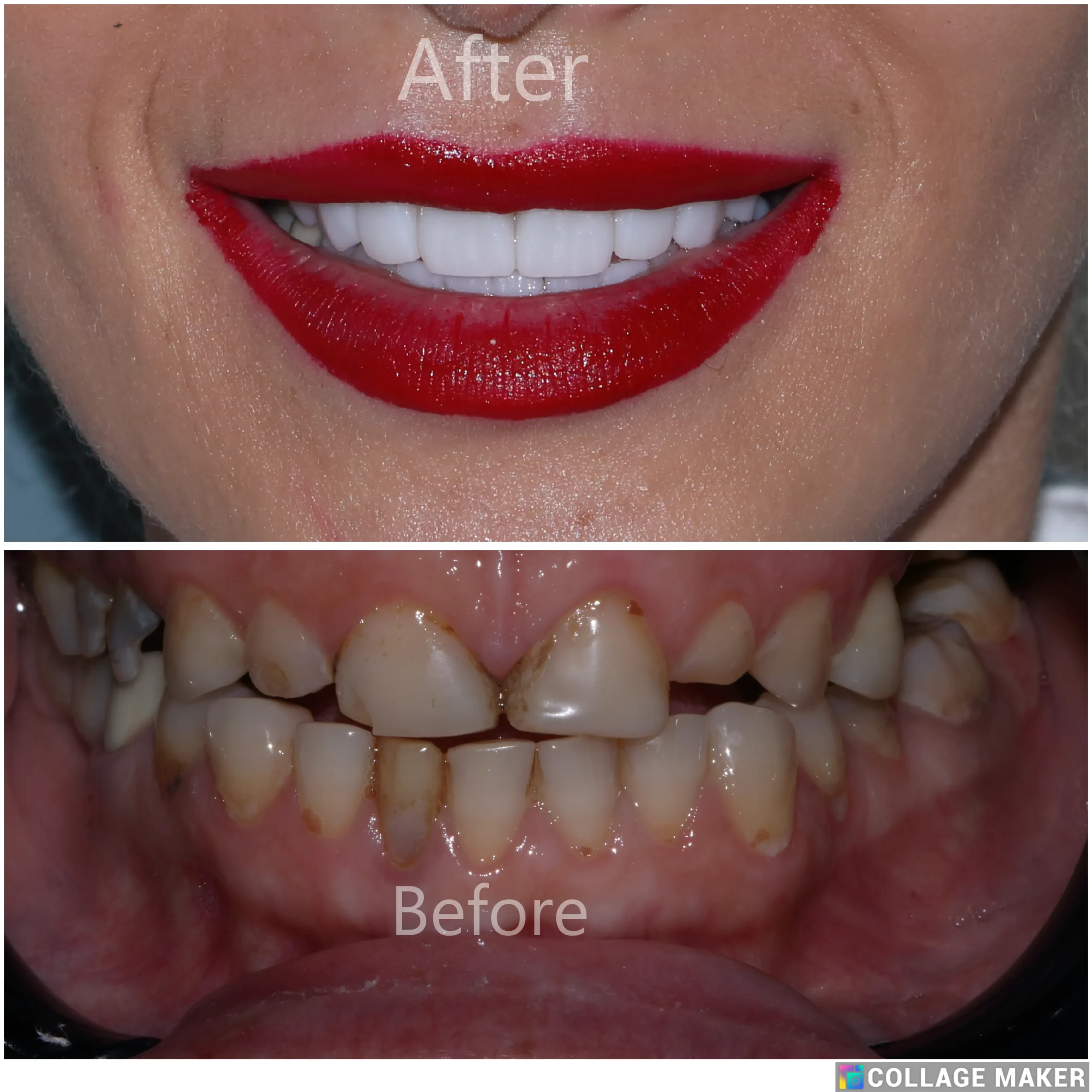 Full Zirconia Dental Restoration