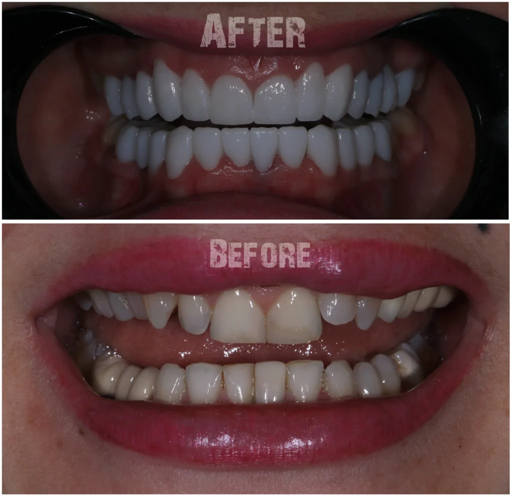 Full zirconia teeth restoration for the upper and lower jaw