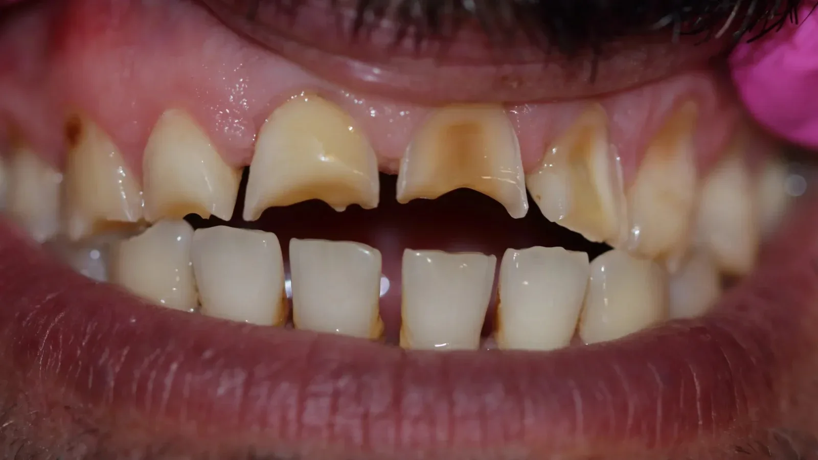 Aesthetic Zirconia Restoration for a Male Patient