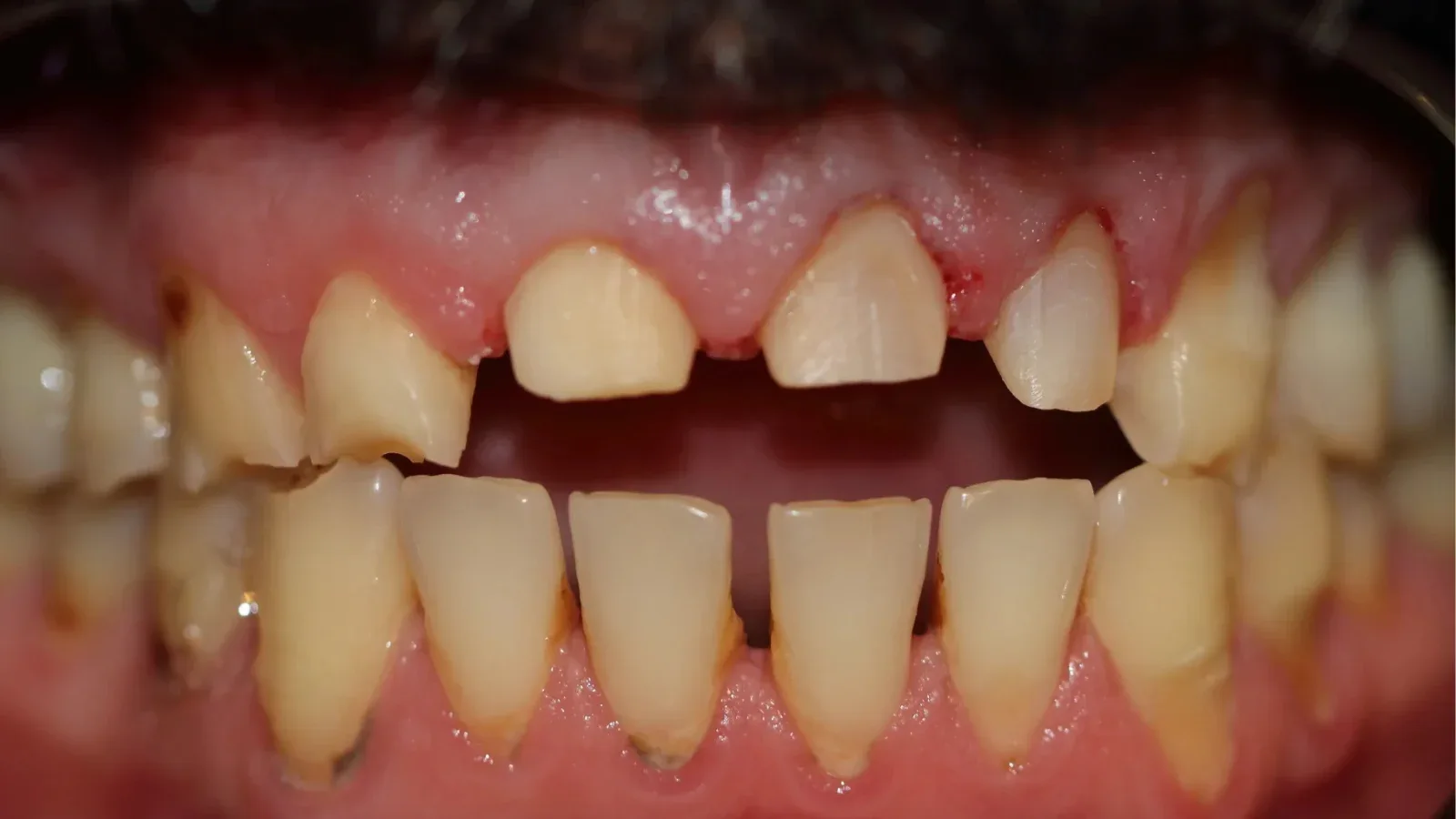 Aesthetic Zirconia Restoration for a Male Patient