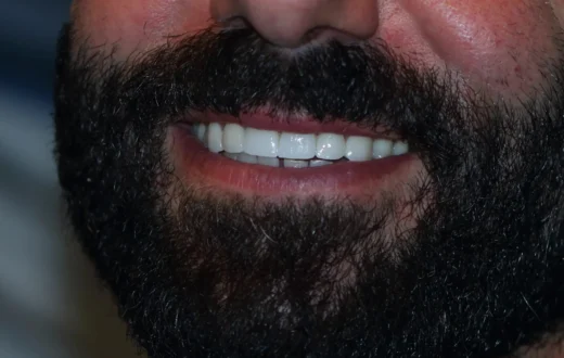 Dental case image: Aesthetic Zirconia Restoration for a Male Patient
