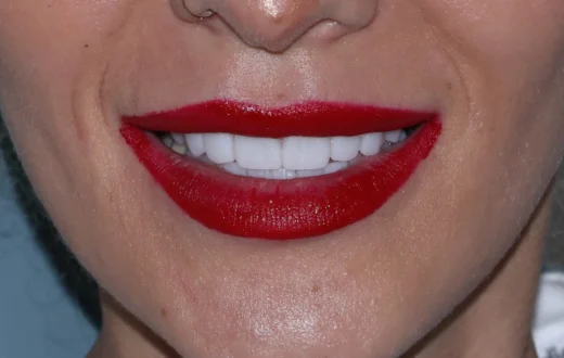 Dental case image: Full Zirconia Dental Restoration with Custom Smile Design…